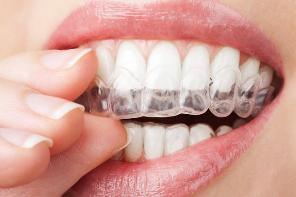 niềng răng ở địa chỉ nào uy tín tại tp HCM